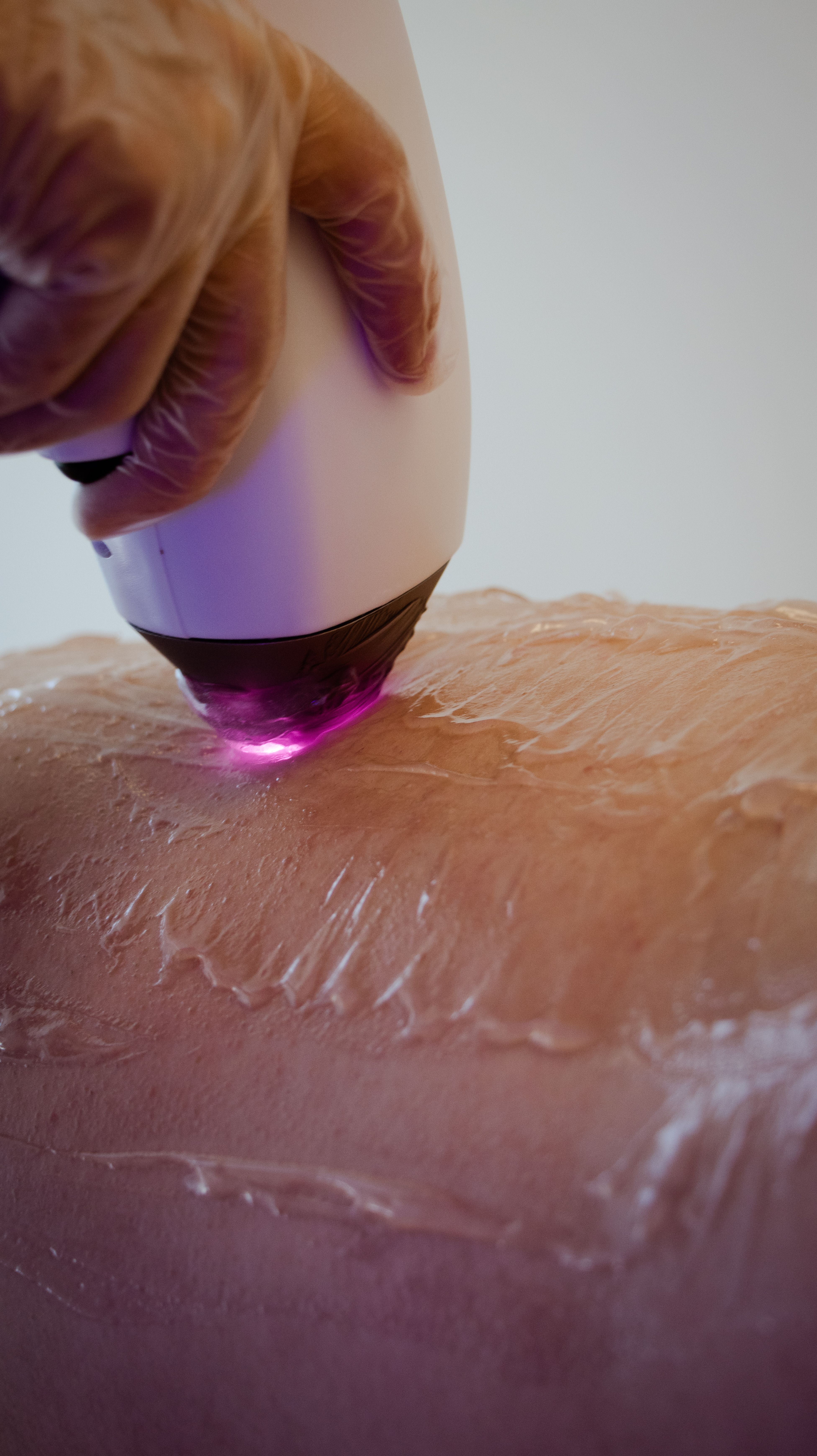 Laser Haarentfernung bei Aida Beauty